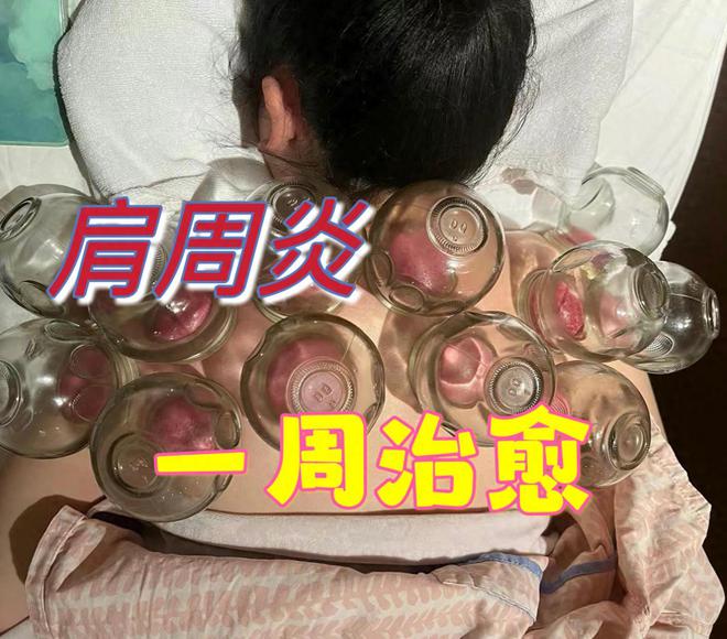 开元棋盘肩周炎反复折磨？中医曝光1个妙招标本同治至今3年未犯！(图1)